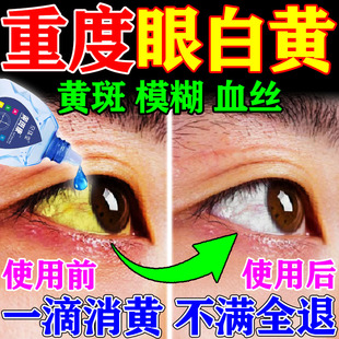 眼白发黄眼睛清澈去黄红血丝浑浊修复眼底黄斑病变滴液药水叶黄素
