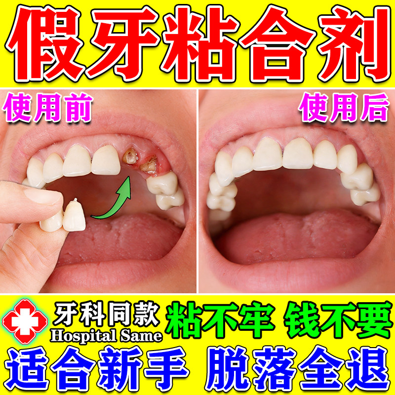 假牙粘合剂稳固医定用粘牙胶水自己粘烤瓷牙专用牙齿冠松动粘接剂