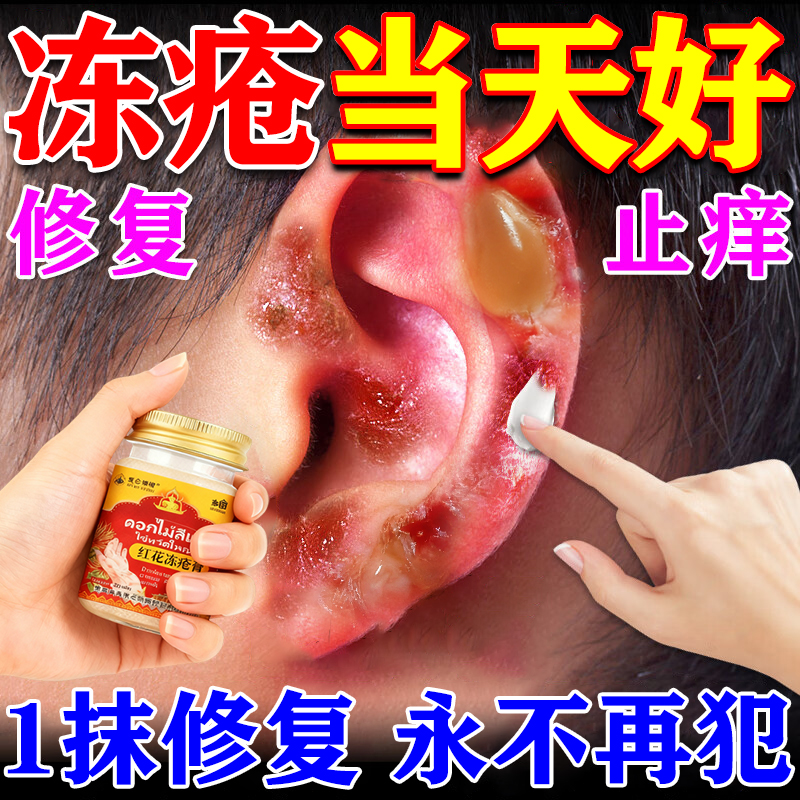 冻疮膏止痒冻伤膏正品排行榜第一