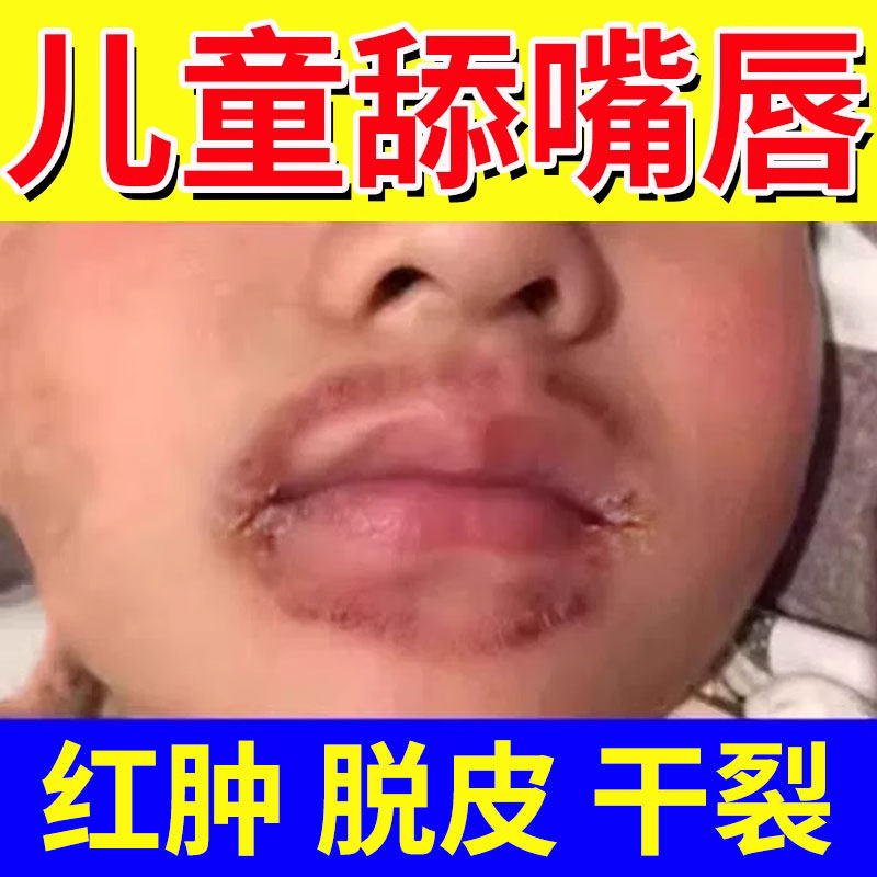 儿童唇膏烂嘴角唇炎可搭膏药贴专用嘴唇口周皮炎干裂脱皮口角炎QQ