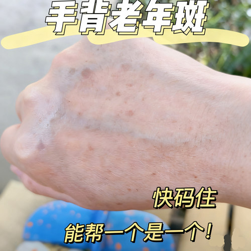 【医用重组胶原凝胶】手背老年斑