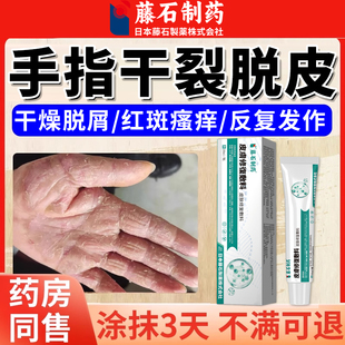 手癣膏脱皮干裂真菌感染鹅掌风专用膏药监备案足癣开裂起皮手痒YY