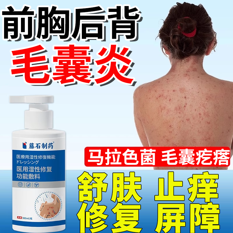 背后长痘痘后背毛囊炎可搭马拉色菌药膏除螨祛痘痒前胸沐浴露ON,保健用品,皮肤消毒护理（消）,淘宝优惠券,粉丝福利购,淘宝优惠卷