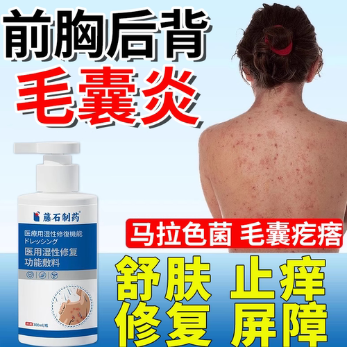 背后长痘痘后背毛囊炎可搭马拉色菌药膏除螨祛痘痒前胸沐浴露ON