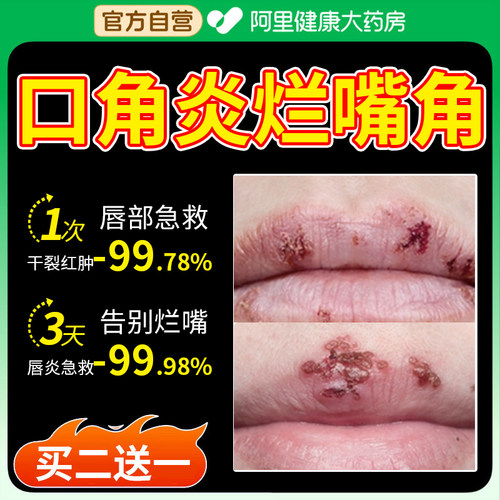 口角炎烂嘴角药膏专唇用疱疹病毒上火起泡周炎唇炎凝胶医用专用