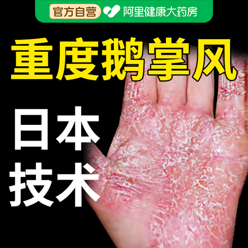 鹅掌风专用手癣膏药干裂止痒汗疱疹脱皮真菌感染角化型手足癣湿疹