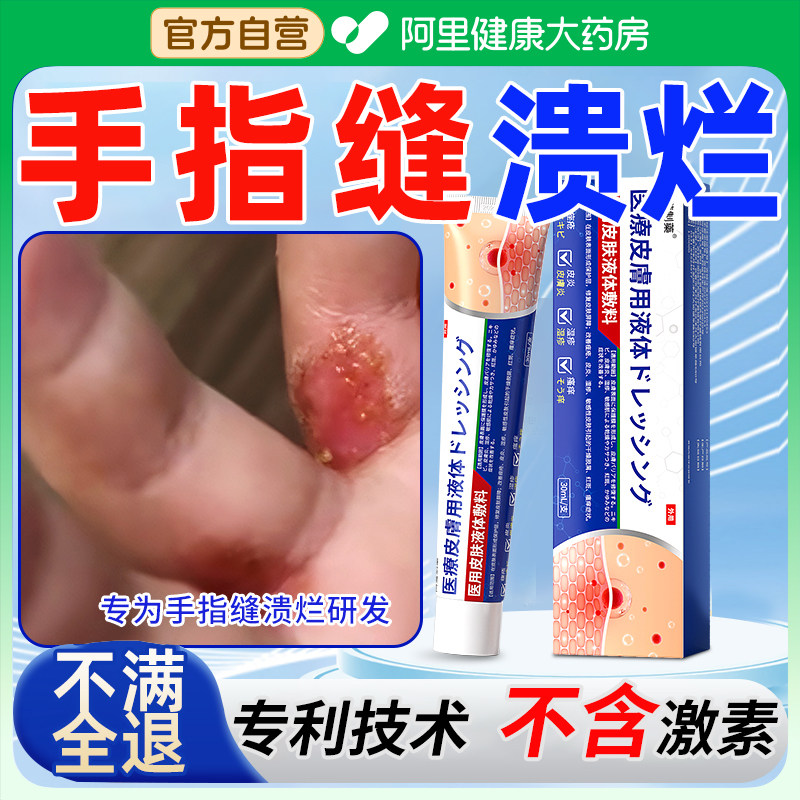 手指缝溃烂止痒脱皮水泡手气糜烂瘙痒手癣膏真菌感染烂手丫间药膏