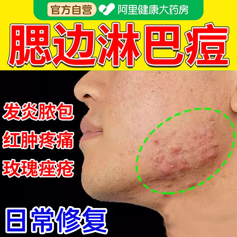 淋巴痘腮边下巴脖子反复长痘痘硬块痤疮上脸颊两边结节玫瑰医用