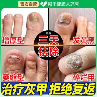 治疗灰指甲专用特效跟药治水第一名凤仙花抑菌液指甲沟炎感染真菌