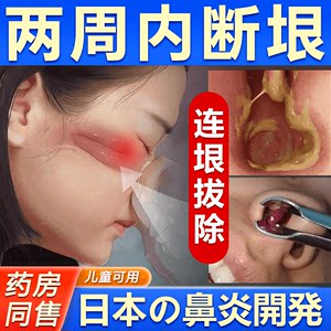 日本治鼻塞通鼻过敏性鼻炎喷雾剂膏鼻腔鼻窦鼻通气神器儿童专用贴