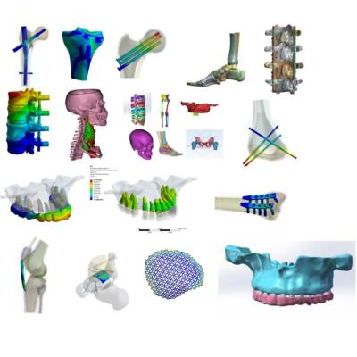 人体mimics建模测量 医学有限元 骨骼有限元代做 ANSYS ABAQUS