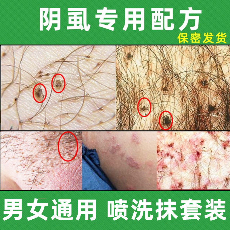 阴虱专用药虫卵双杀一扫光药男士用私处灭成人百部酊男女通用药水