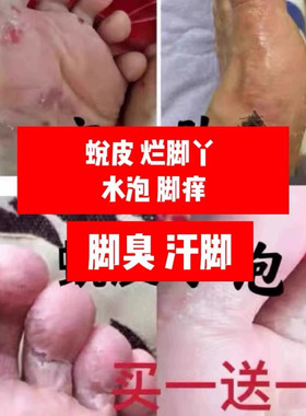 脚气止痒专用去脚臭根神器脚痒烂脚丫水泡型脱皮脚汗泡脚包杀
