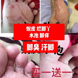 脚气止痒专用去脚臭根神器脚痒烂脚丫水泡型脱皮脚汗泡脚包杀