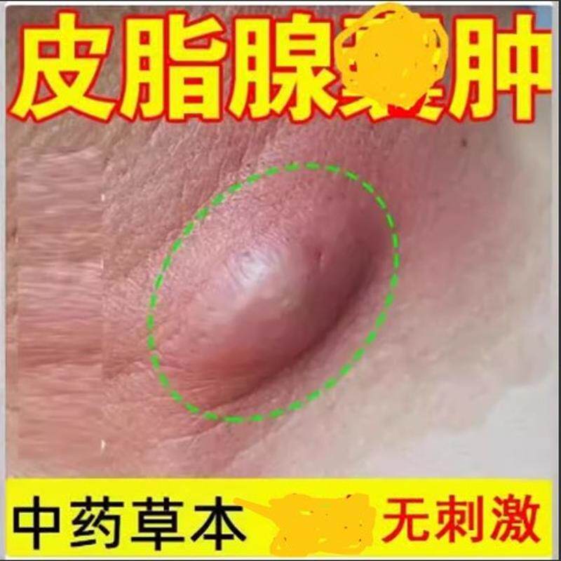 皮脂腺囊肿膏皮下囊肿粉刺痤疮脓包拔脓膏火疖子拔毒器