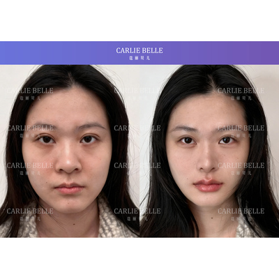 蔻丽贝儿qu眼袋泪沟丰太阳穴50000+成功案例代拍链接 面部高光点