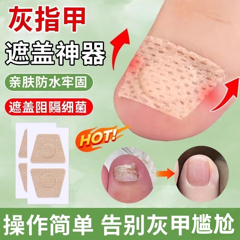 灰指甲专用药膏重度厚甲脚趾手指