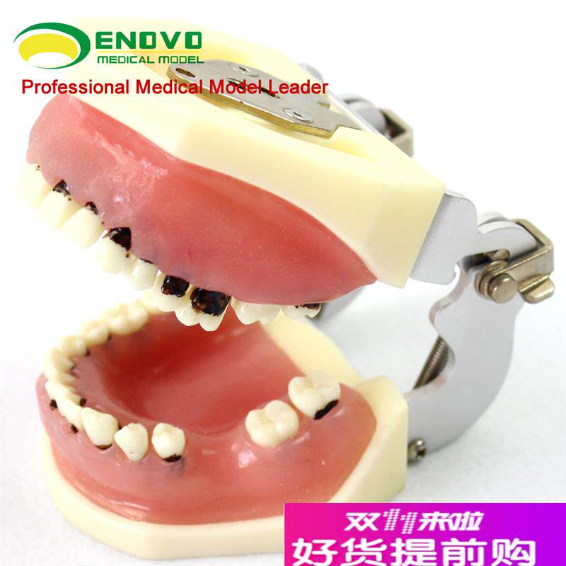 颐诺正品a口腔重度牙周病学模型牙结石刮治牙龈缝合模型分瓣术