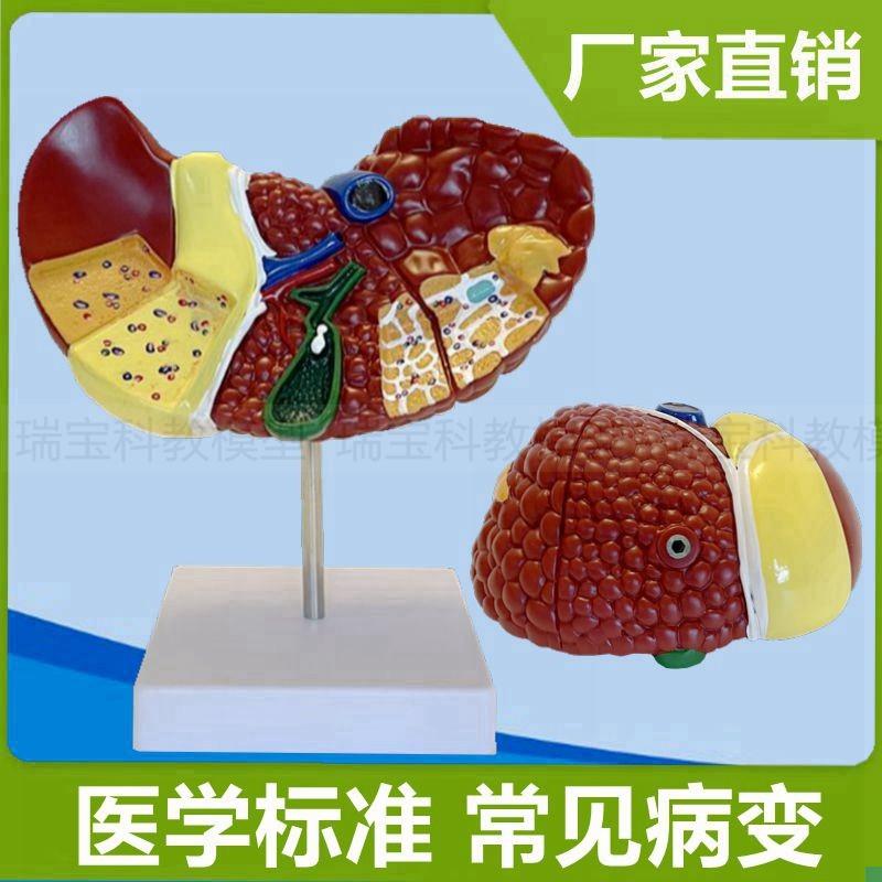 病变肝脏模d型医患沟通消化医药礼品临床医生解剖人体肝脏结构模