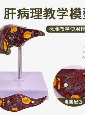 肝脏模型肝脏病k理模型脂肪肝肝硬化肝的癌肝胆病变肝解剖模型