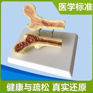 骨质密度模型疏松股骨头仿真塑胶骨头人体松质骨骨W小梁医药礼品