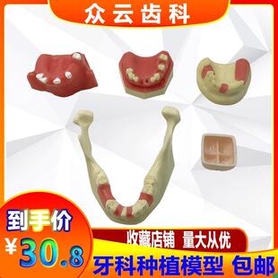上颌窦提升操练模型种植牙练习模型口腔种植软V牙龈齿科材料