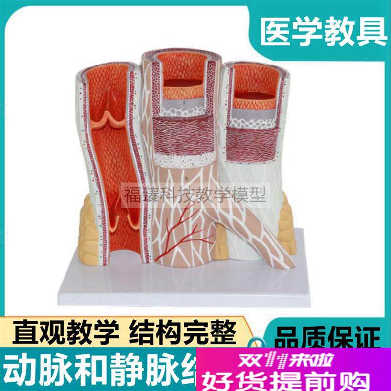 动脉静脉血管结i构冠状血管内膜斑块破裂脂肪粥样栓子阻塞狭窄病