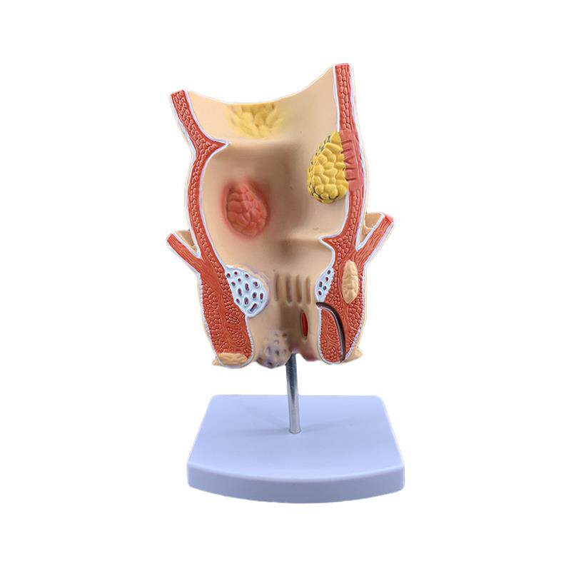 直肠模型病理大肠模型痔疮演w示医院用教学人体模型器官解剖模型