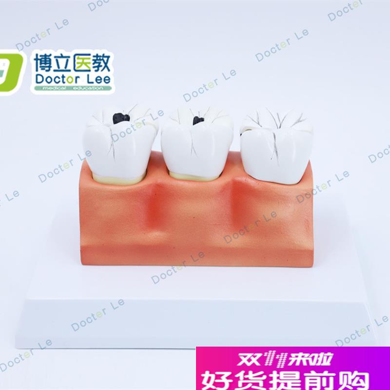 教学仿真龋齿模型牙齿模型病变牙齿模型J3颗龋齿模型龋齿分解模型