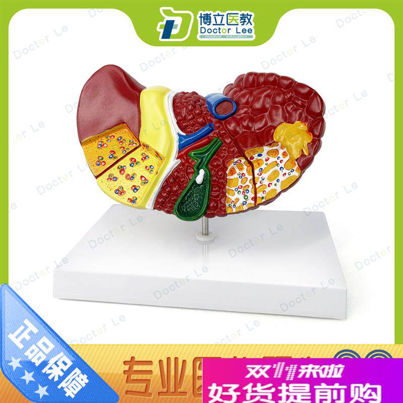 肝脏模型肝脏病理模型肝解剖模型H肝胆胰脾十二指肠消化系统