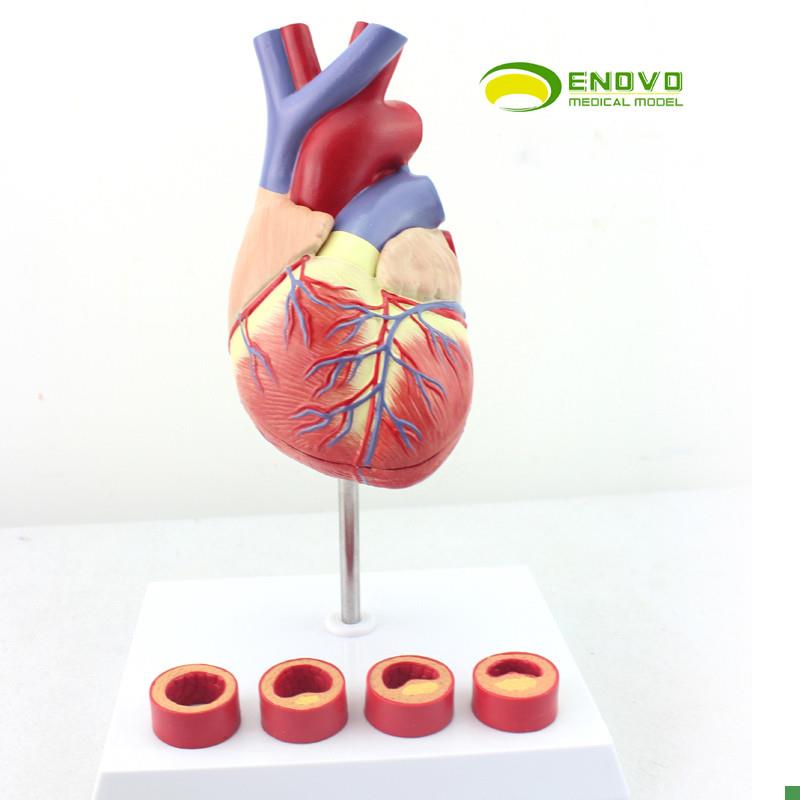 ENOVOc颐诺1:1医学人体心脏模型冠状动脉血栓心内科教学动脉粥样