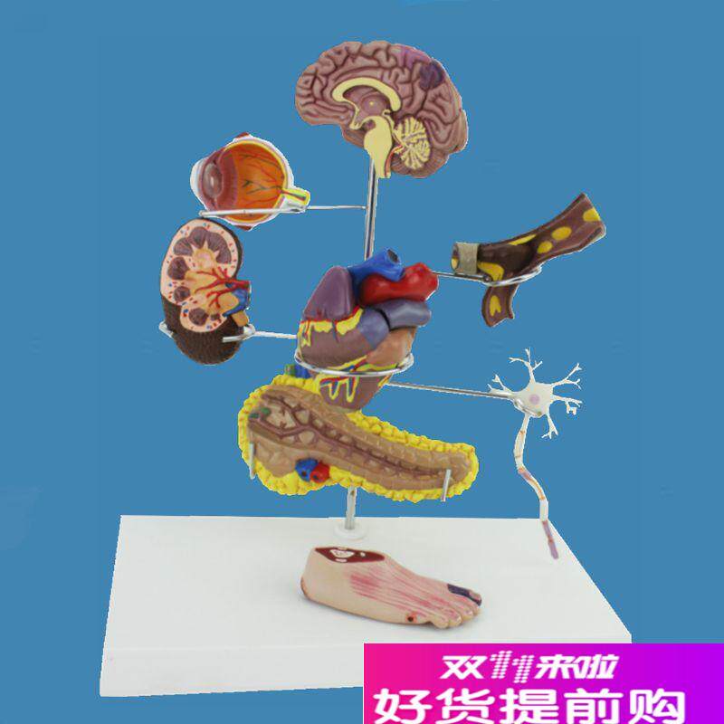 内分泌糖尿模型心血管阻塞视网膜足脚病理器官受损并Y发症心脏胰