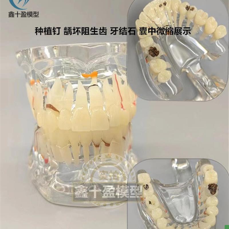 牙科牙齿模型2倍透明q牙体综合病理模型口腔科病理模型医患模型