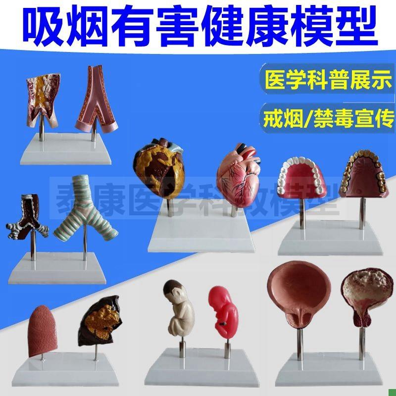 戒烟教育模型吸烟有害健康人体A器官受损心脏血管肺气管膀胱牙齿