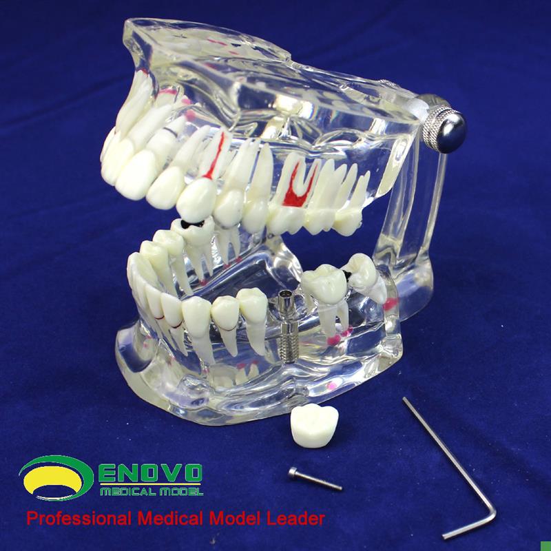 ENOVaO颐诺牙齿模型口腔牙齿科种植模型口腔病理模型种植体牙冠义