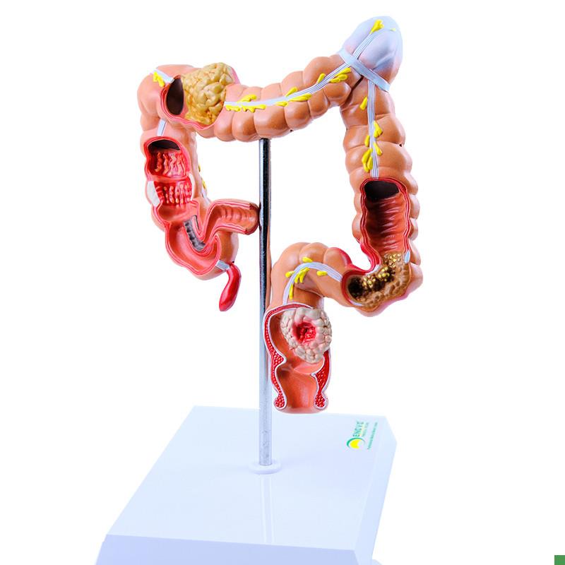ENOVO颐g诺人体大肠疾病展示模型结肠直肠道病变症状消化系统疾病