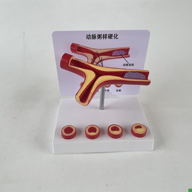 人体血管病理粥样动脉/硬化模型A病变血栓/血管/病演示心解剖教具