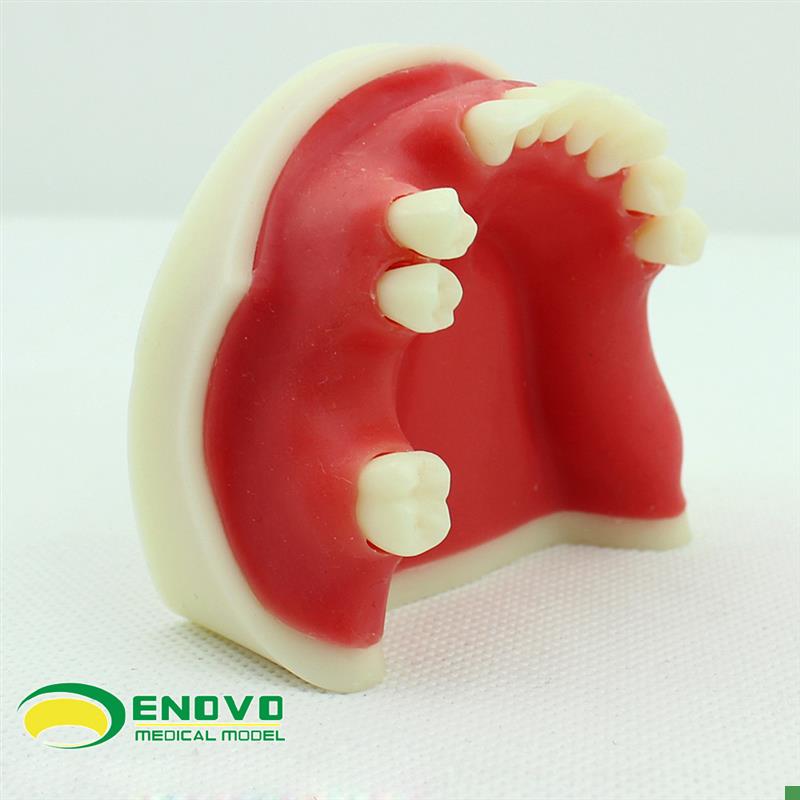 ENOVO颐诺口腔种植仿真下颌骨缺失F牙模型种植体牙医齿科牙齿模型
