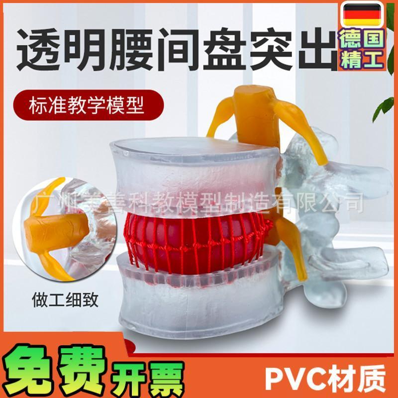 腰椎放大腰椎间盘模型挤压突出演示脊柱脊Q椎骨病理演示模型