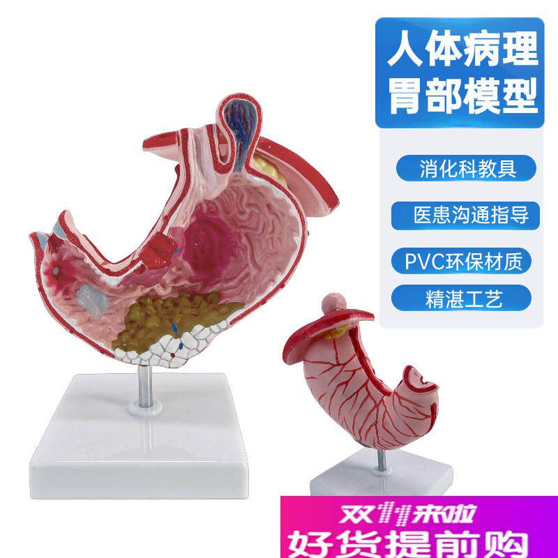 人体胃解剖模型放大o胃结构胃镜教学病理胃解剖模型病态胃模型