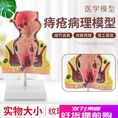 大号人体直肠模型结肠p病理直肠痔疮直肠常见病模型直肠和肛管模