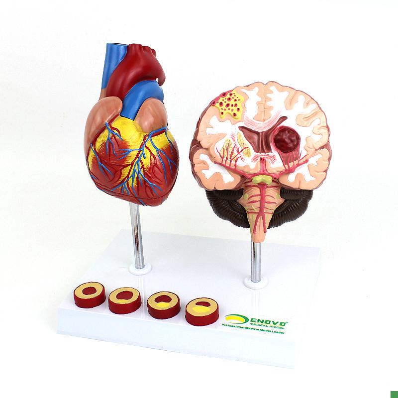 ENOVO颐诺心脑血管疾病展示模型高血L压心脏心血管疾病模型脑