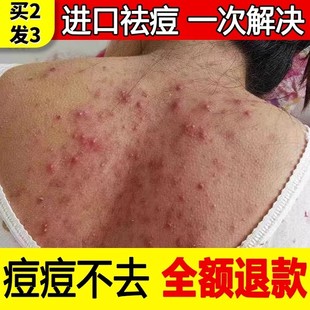 后背祛痘去背部胸前胸口背上身体长痘去痘除去螨虫痘印神器非喷雾