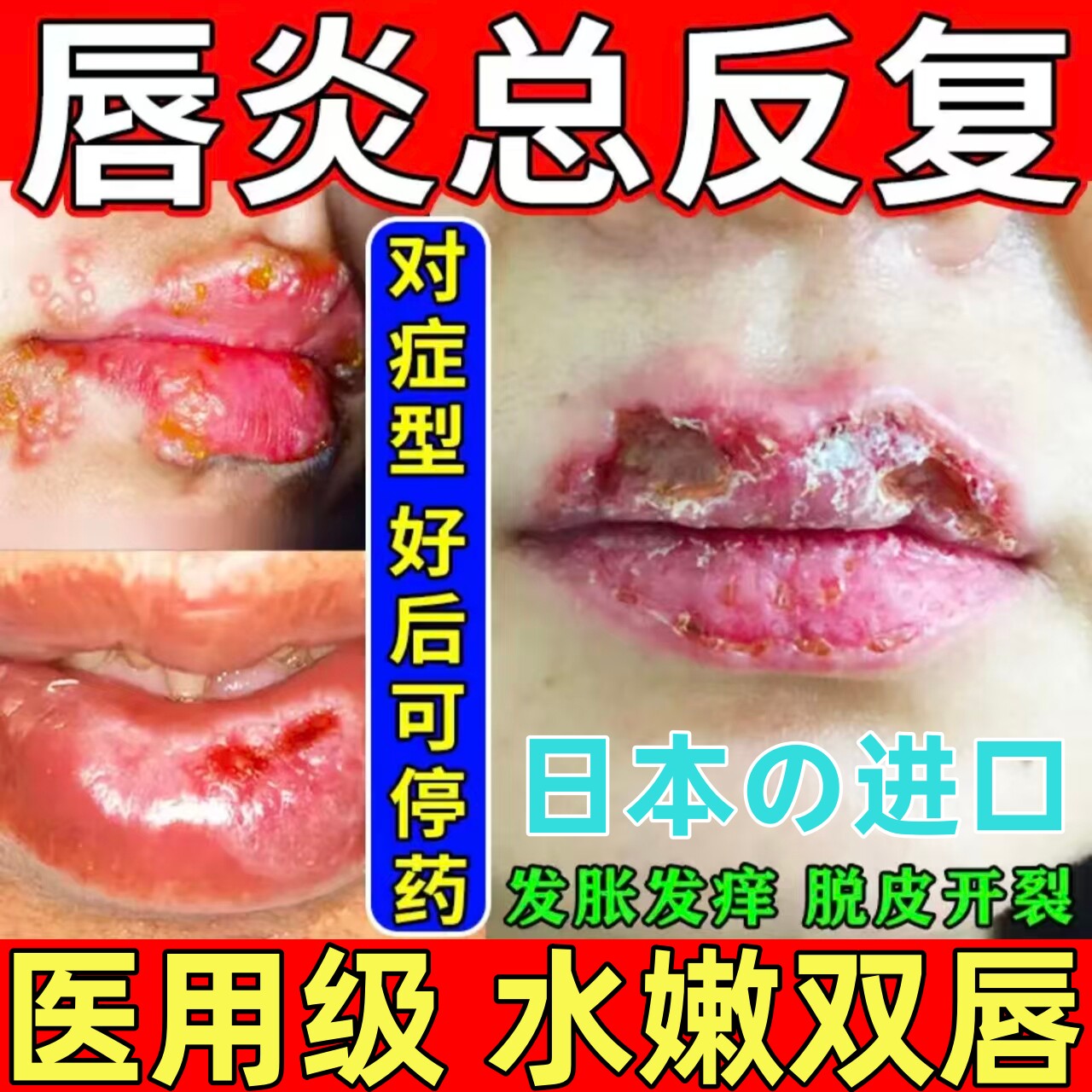 日本唇炎唇膏嘴唇干裂脱皮医用型儿童嘴角防开裂药修护专用润唇膏