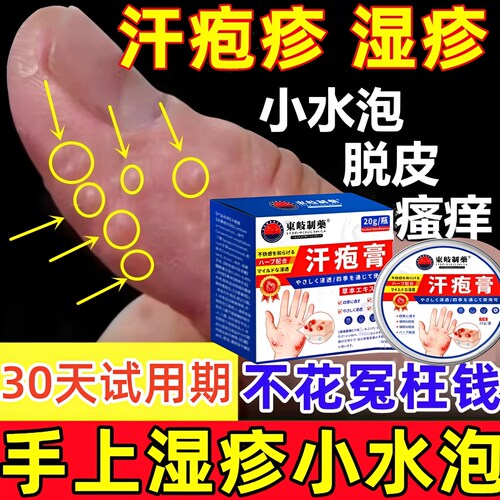 汗疱泡疹止痒根去专用膏药手上起小水泡汗状疹疱真菌感染特效软膏