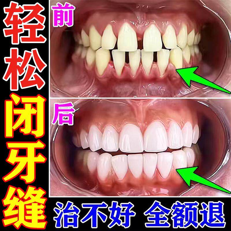 牙缝宽大修复神器门牙缝隙大矫正吃饭塞牙牙龈萎缩缝隙填充剂牙膏