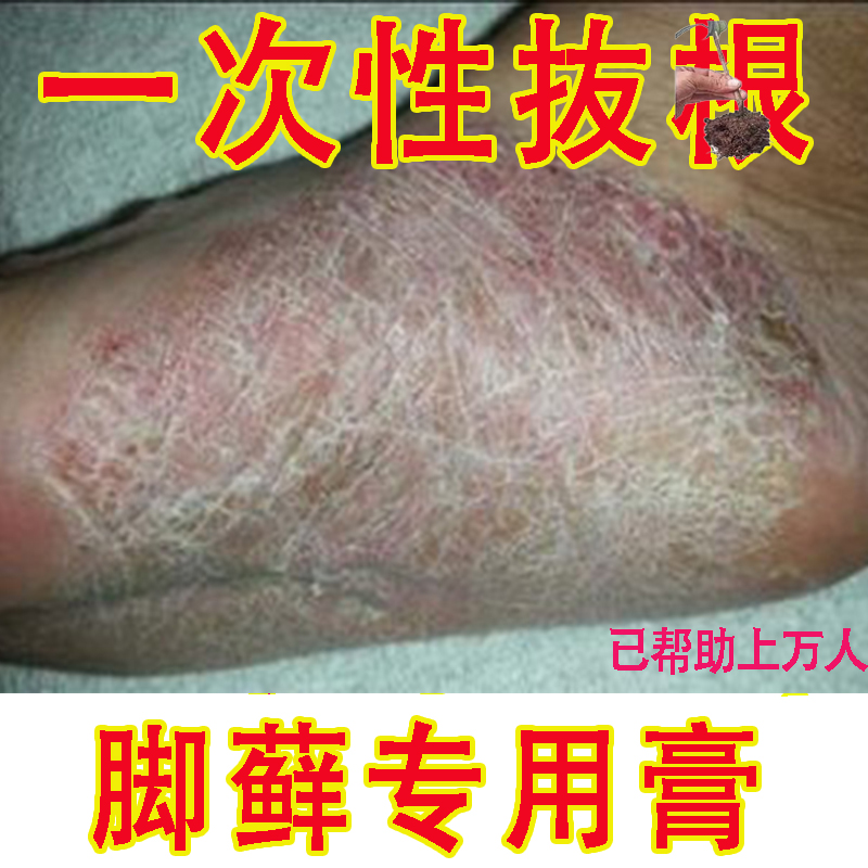 脚气脚藓止痒真菌感染水泡烂脚丫足藓脚痒抑菌止痒膏