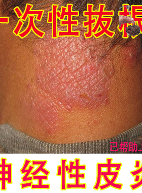 神经性皮炎外用膏根苗家配方顽固皮肤藓去真菌感染止痒除正品