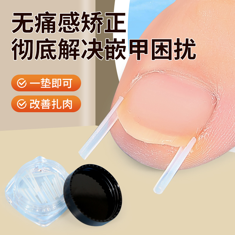 甲沟矫正器正甲垫矫正神器