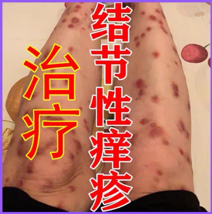 结节性痒疹 耱耋鼗 膏和药水组保健理疗